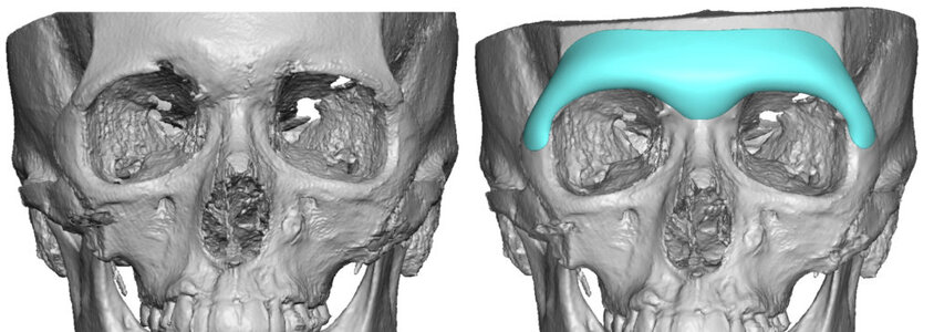 3396545 3 Extended male Custom Brow Bone Implant design Dr Barry Eppley Indianapolis 1024x364