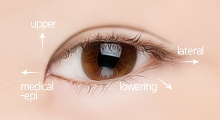 Canthoplasty 5