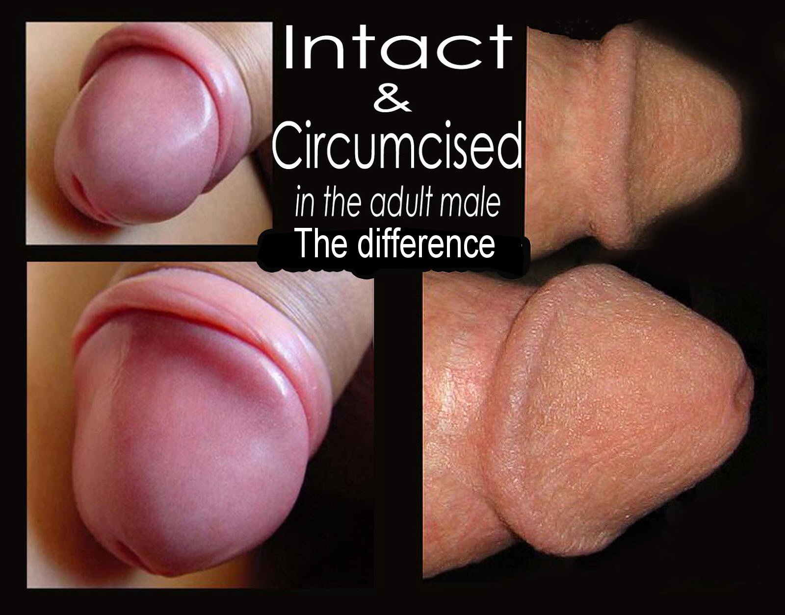 circumcision-intact-jpg.2372008